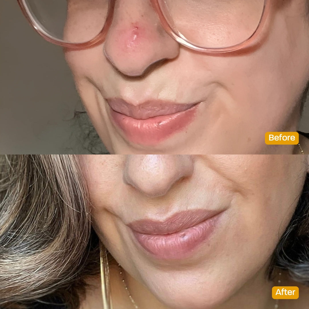 Faeves by Céleste | Clarifying LED Patch - Targeted LED Light Therapy